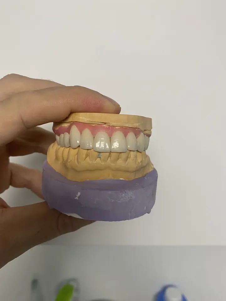 Crowns on a model of the teeth