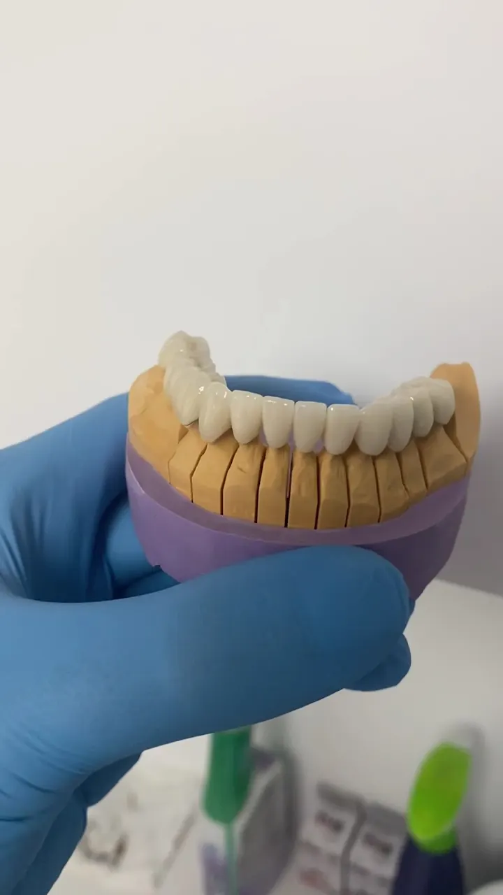 Crowns on a model of the teeth