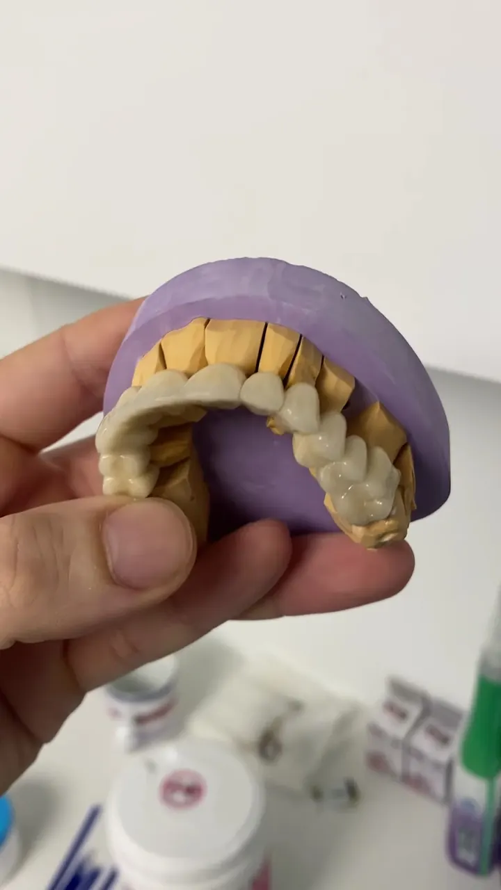 Crowns on a model of the teeth