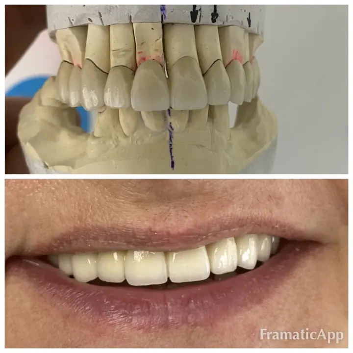 Model of new teeth and the final smile