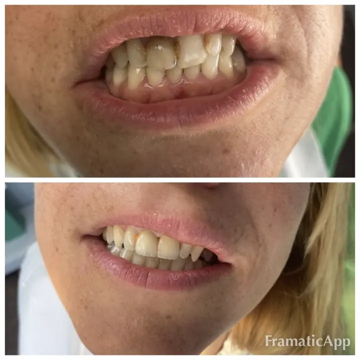 Smile before and after treatment