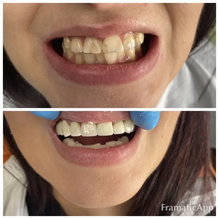 Smile before and after treatment