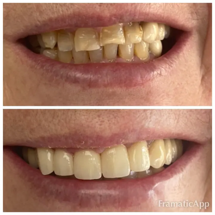 Smile before and after treatment