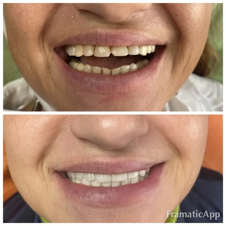 Smile before and after treatment