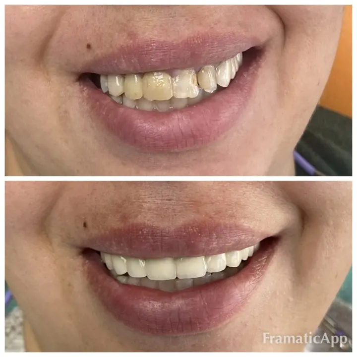 Smile before and after treatment
