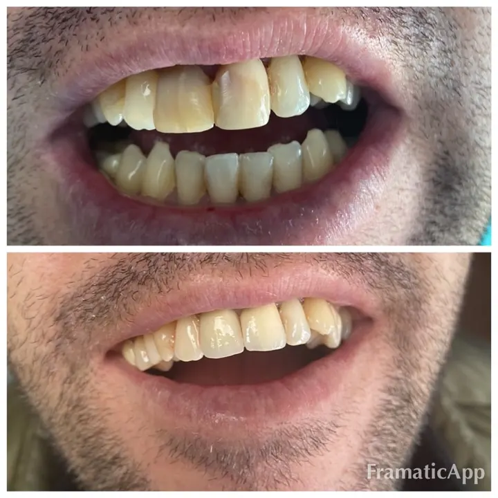 Smile before and after treatment