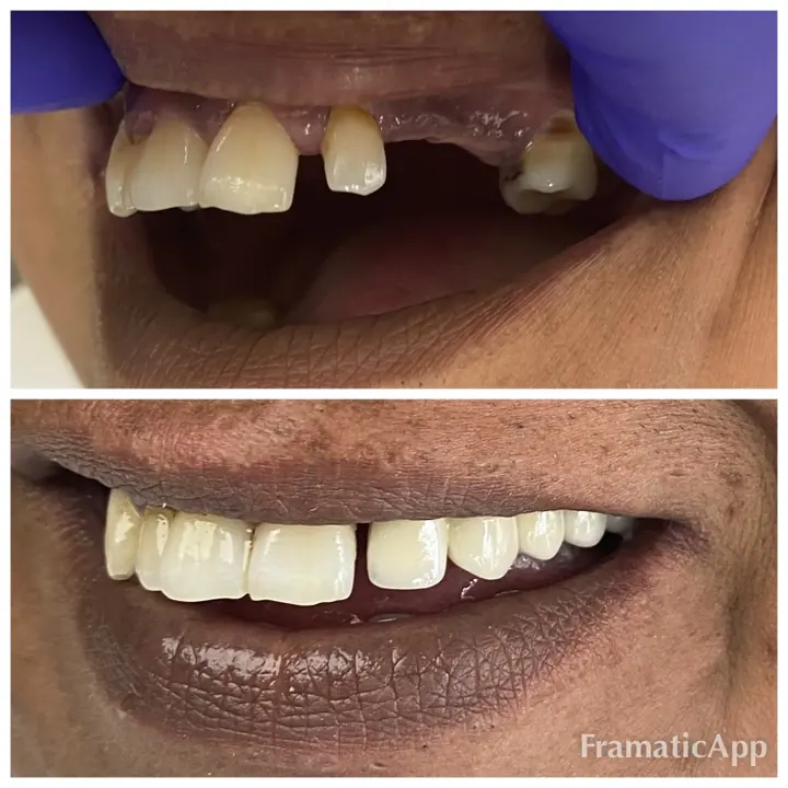 Smile before and after treatment