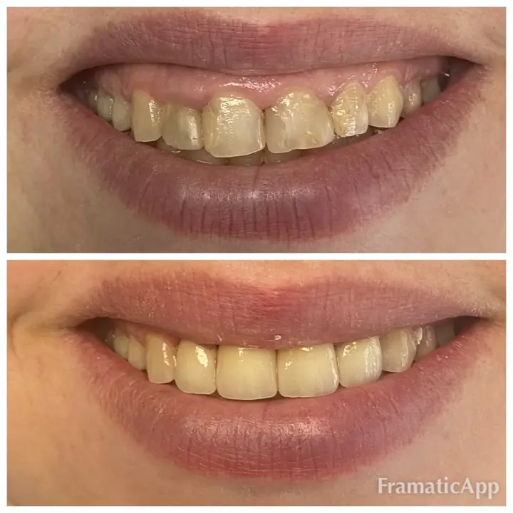 Smile before and after treatment
