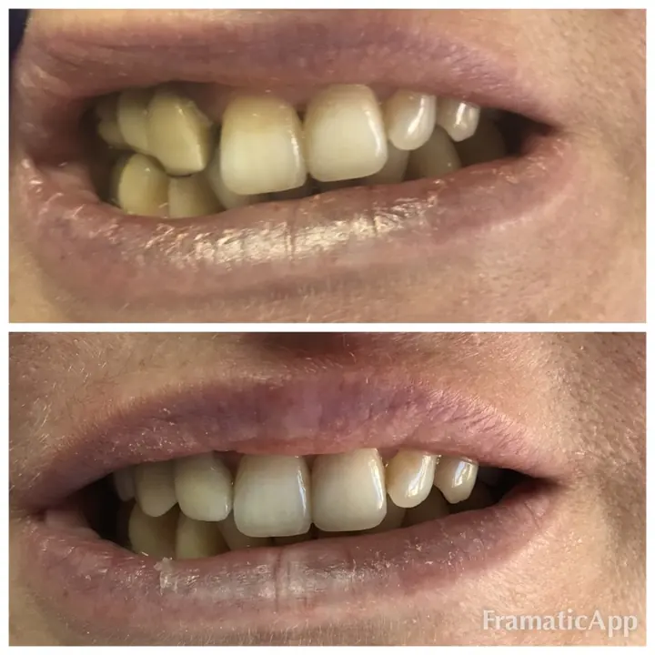 Smile before and after treatment