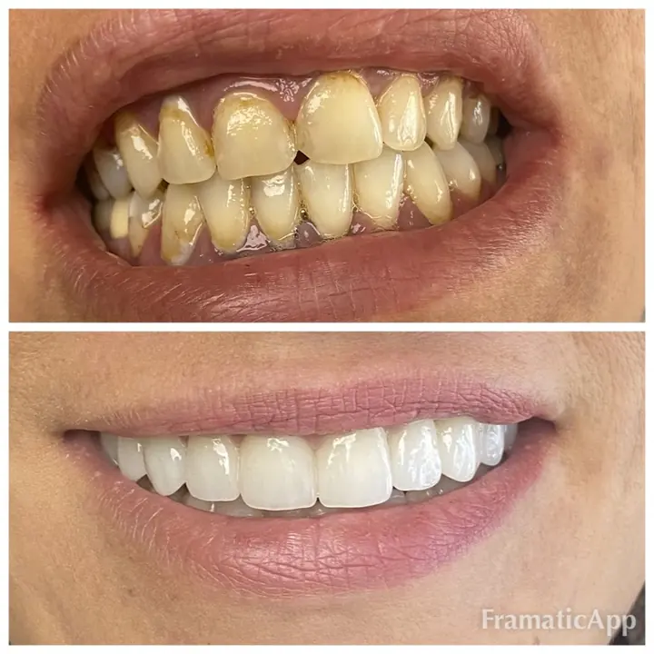 Smile before and after treatment